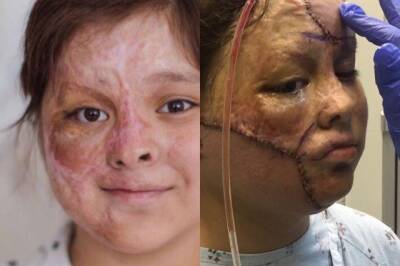 Кричала и плакала от боли: история новосибирской девочки со сгоревшим лицом