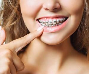 Брекеты на зубы: что нужно знать перед установкой?