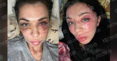 Избитая бойцом ММА москвичка показала увечья на фото