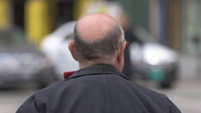 Выпадение волос стало частой жалобой россиян после перенесенного COVID-19