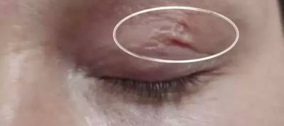 Хирурги достали 9-сантиметрового паразита из глаза украинки (фото)
