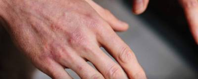 Ложное обморожение пальцев внесли в перечень симптомов кожного проявления COVID-19