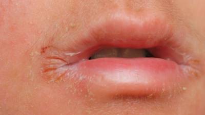 От инфекций до язвы: сухие губы назвали признаком серьезных заболеваний