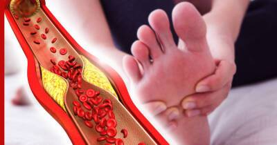 Высокий холестерин: симптомом опасного состояния назвали необычный признак на ногах