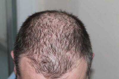 Трихологи озвучили нестандартные причины выпадения волос