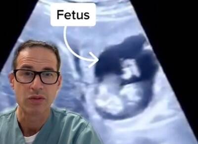 В Канаде беременная женщина вынашивала эмбриона в печени