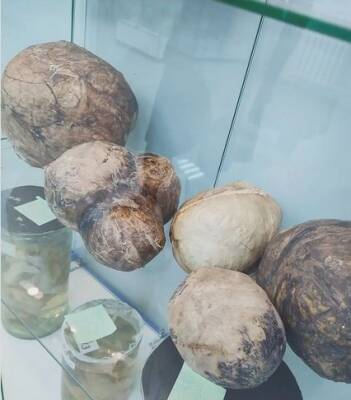 Гигантские опухоли покажут нижегородцам в музее ПИМУ