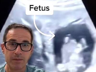 В Канаде врач обнаружил эмбрион в печени пациентки