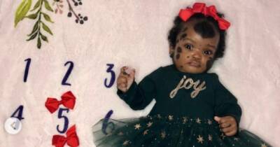 В США родилась необычная девочка с пятнами по всему телу (фото)