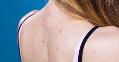 Ученые назвали симптом омикрон-штамма COIVD, заметный на коже