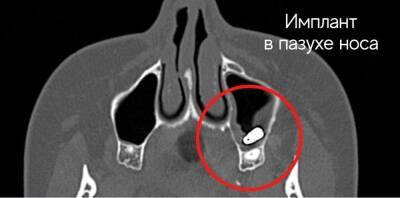 Нижегородский ЛОР-врач извлек зубной имплант из носа пациента