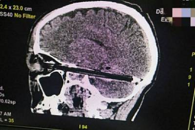 Названа причина попадания шариковой ручки через глаз в мозг пациента из СИЗО