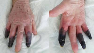 Врачи ампутировали пожилой женщине «ковидные» пальцы