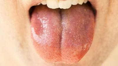 Онкологи назвали шесть признаков рака полости рта