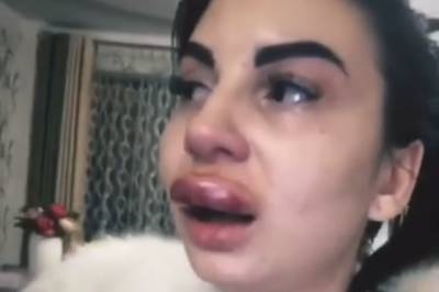 «Срочно к врачу»: хирург прокомментировал состояние девушки с обезображенной губой