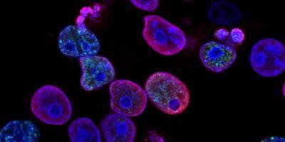 Израильские ученые обнаружили «ахиллесову пяту» раковых клеток