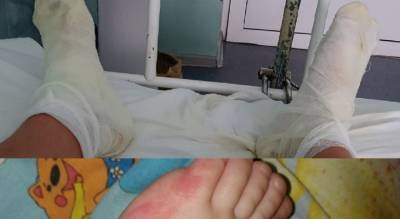 "Выносил детей на руках, шлепая по кипятку": в Рыбинске обварилась семья