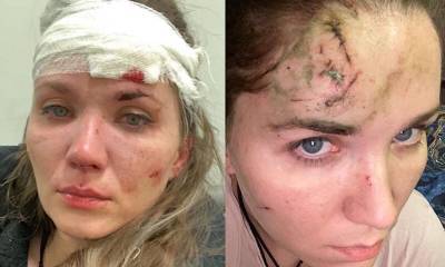 «Пол-черепа онемело, глаз не открывался»: Анастасия Веденская о последствиях нападения