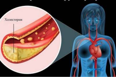 Как узнать, что артерии забиты: 9 сигналов организма