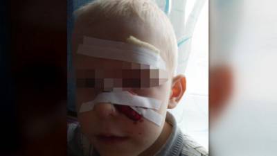 Пятилетний мальчик упал лицом на металлические штыри в Пензенской области