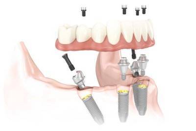 Имплантация зубов методом «All-on-four» (Все на четырех)