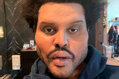 Певец The Weeknd показал ужаснувшие фанатов последствия «пластической операции»