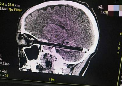 В Ростове нейрохирурги извлекли авторучку из мозга мужчины
