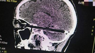 Ростовские нейрохирурги извлекли из мозга мужчины авторучку