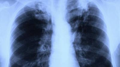 В Подмосковье сообщили о снижении на 20% заболеваемости туберкулезом