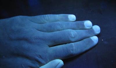У переболевших коронавирусом начали в ультрафиолете светиться ногти