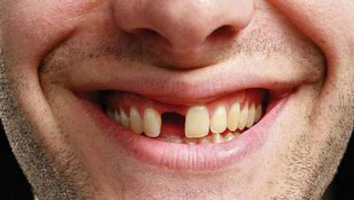 Связь между продолжительностью жизни и выпадением зубов нашли стоматологи