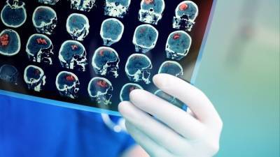 Какие безобидные симптомы могут говорить о раке мозга?