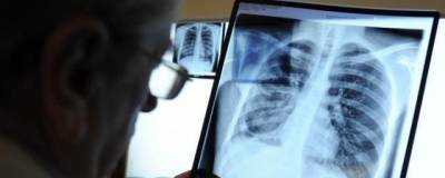 Доктор Мясников предупредил об угрозе волны туберкулеза в России