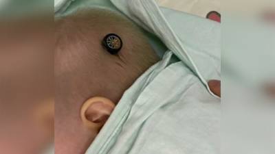 Московские врачи спасли малышку от пробившего голову колесика