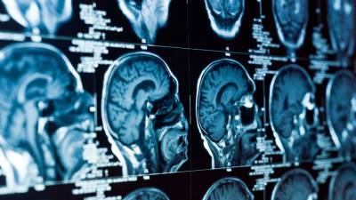 Российские врачи разработали методику лечения неоперабельного рака мозга