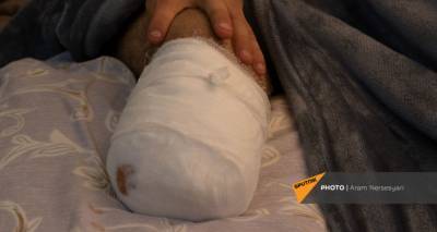 Начнут закупать протезы из Европы: министр назвал число тяжелораненых в Армении