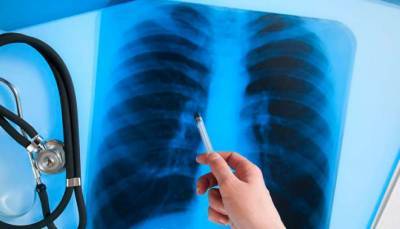В Украине снизилась заболеваемость открытой формой туберкулеза
