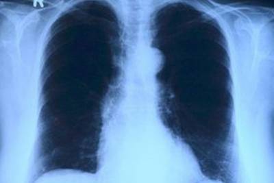 Диагностика COVID путем КТ в Татарстане помогает выявлять туберкулез