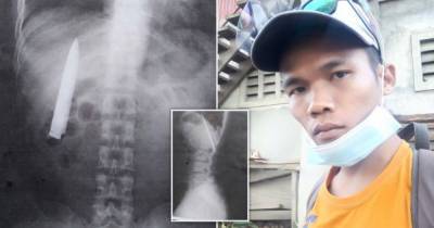Филиппинец обнаружил, что больше года жил с ножом в груди