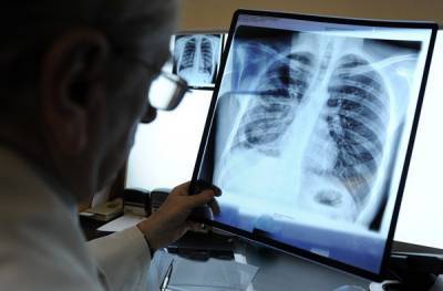 Главный фтизиатр Минздрава предупредила о возможности всплеска туберкулёза из-за пандемии коронавируса