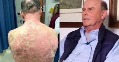 Пациент сделал вакцину от CoViD и через четыре дня в шоке обнаружил, что его кожа начала слезать