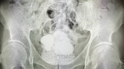 Полкилограмма камней извлекли врачи Ишима из мочевого пузыря пациента