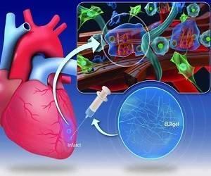 Кардиологи смогли восстановить сердечную мышцу после приступа