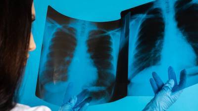 В Минздраве РФ назвали срок восстановления дыхательной функции после COVID-19