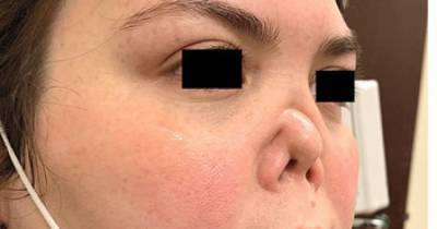 В США у женщины провалился нос: как это произошло (фото)
