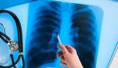 В Украине зарегистрировали около 1,7 тысячи случаев туберкулеза - hubs.ua