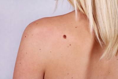 Британские медики рассказали о трех признаках рака кожи