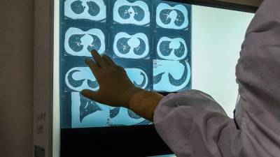 Отечественная нейросеть выявляет ковид по рентгеновским снимкам
