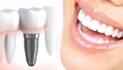 Врач-стоматолог подробно рассказала про дентальные имплантаты