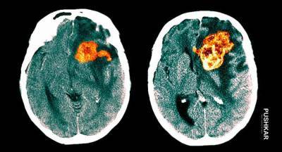 Израильские ученые заявляют, что могут вылечить самый агрессивный рак мозга